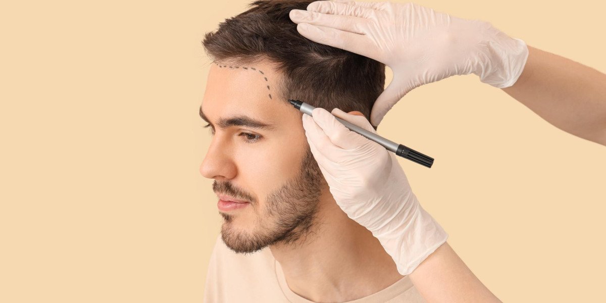 10 Things No One Tells You Before Getting a Hair Transplant