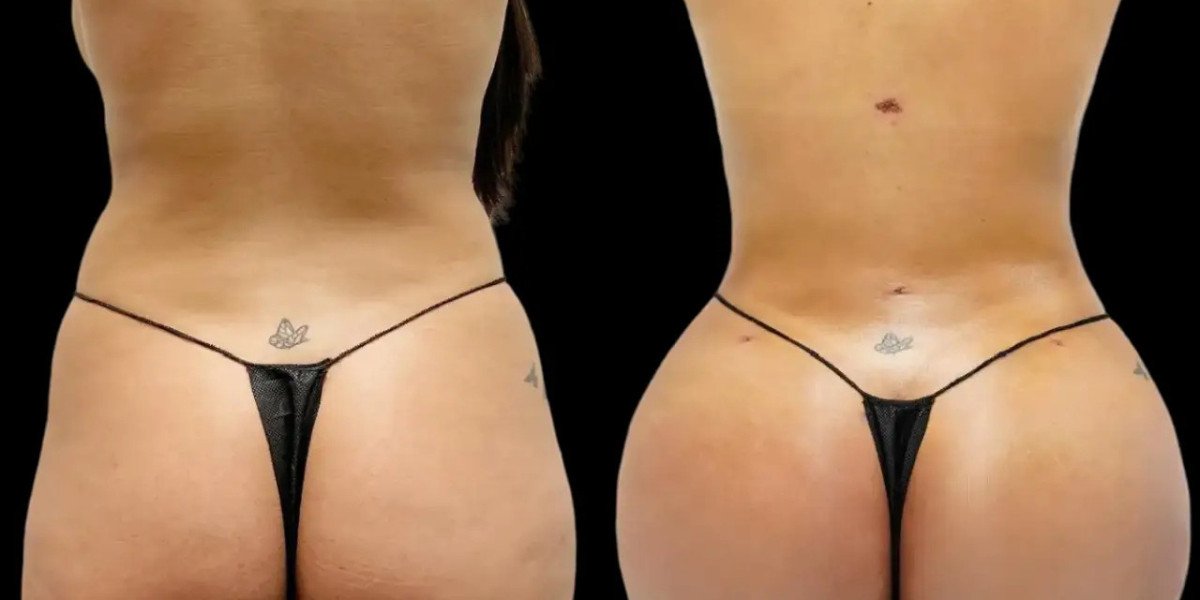 Fat Transfer in Dubai: Understanding the Importance of Aftercare