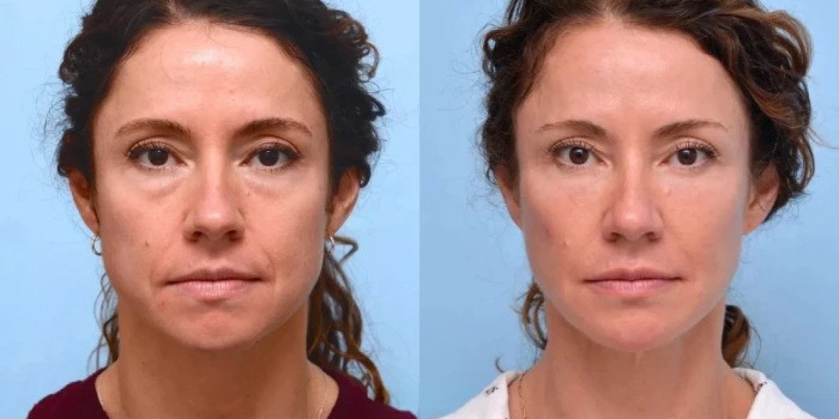 Best Plastic Surgeons in Dubai Offering Professional Thread Lift Solutions